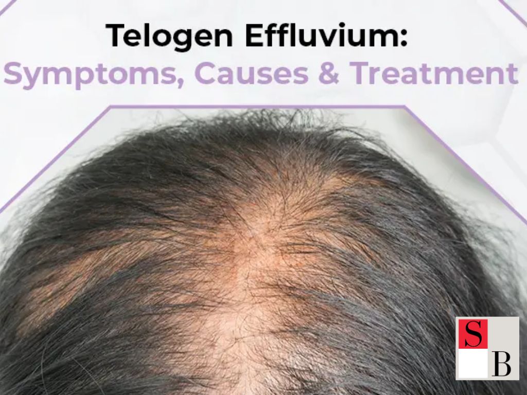 Understanding Post-COVID Hair Loss in Singapore