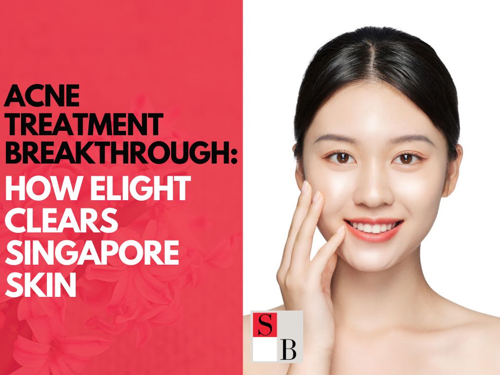 Acne Treatment Breakthrough: How Elight Clears Singapore Skin