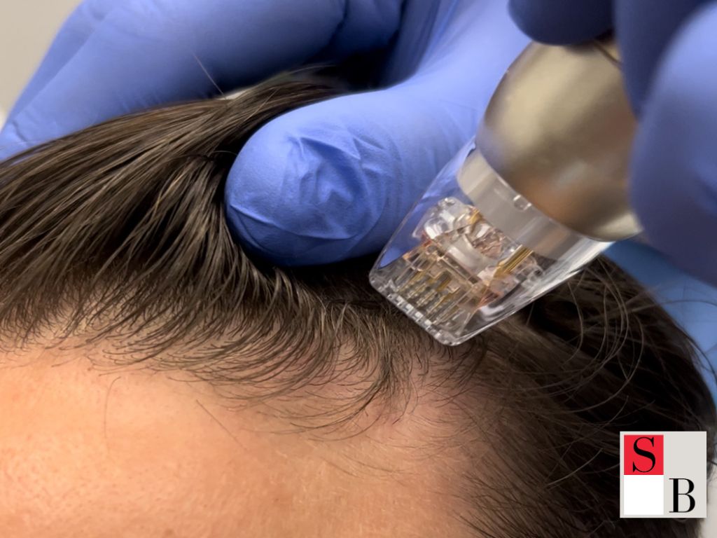 Professional Hair Loss Treatments at Wellaholic Somerset