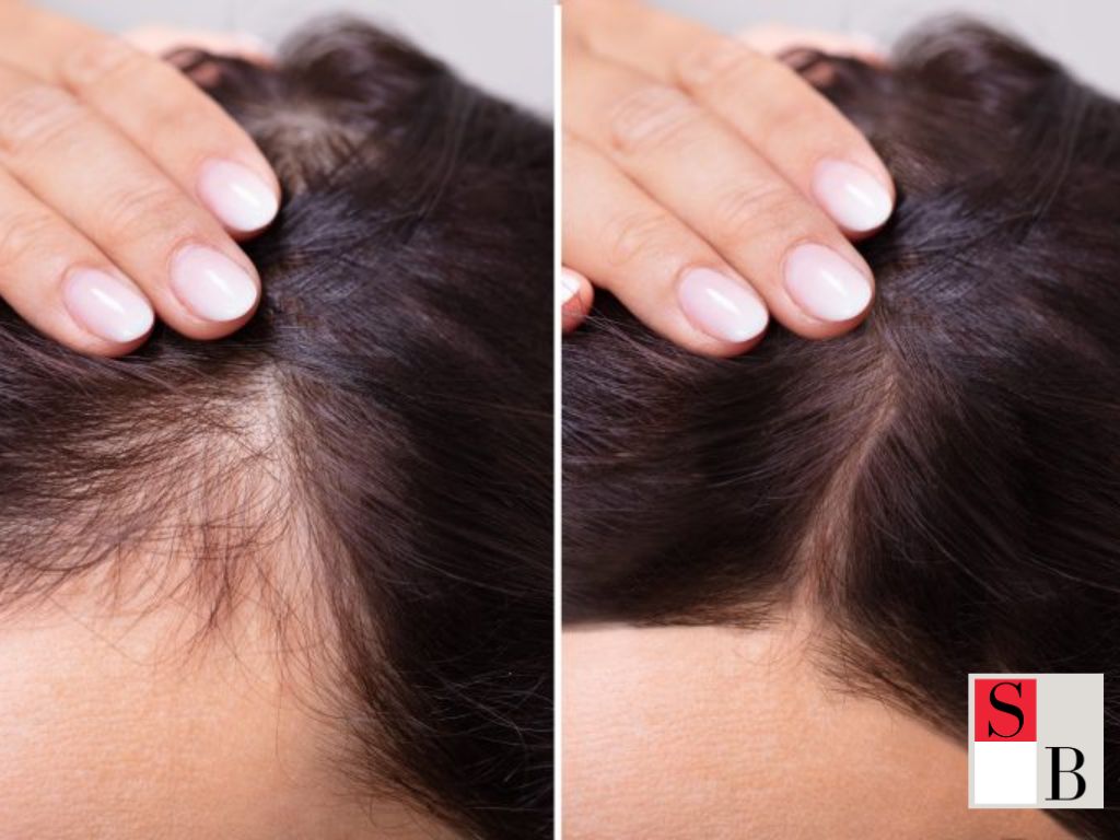Why Addressing Hair Loss Matters for Women in Singapore