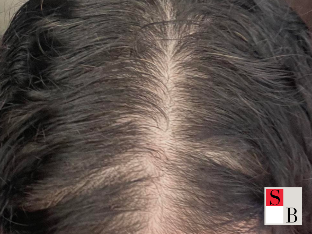 Why Early Intervention Matters for Hair Thinning
