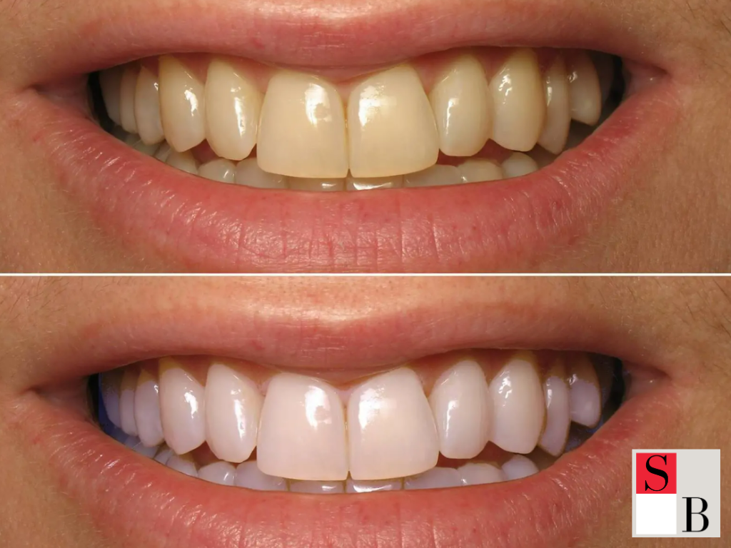 Practical Whitening Considerations in Singapore