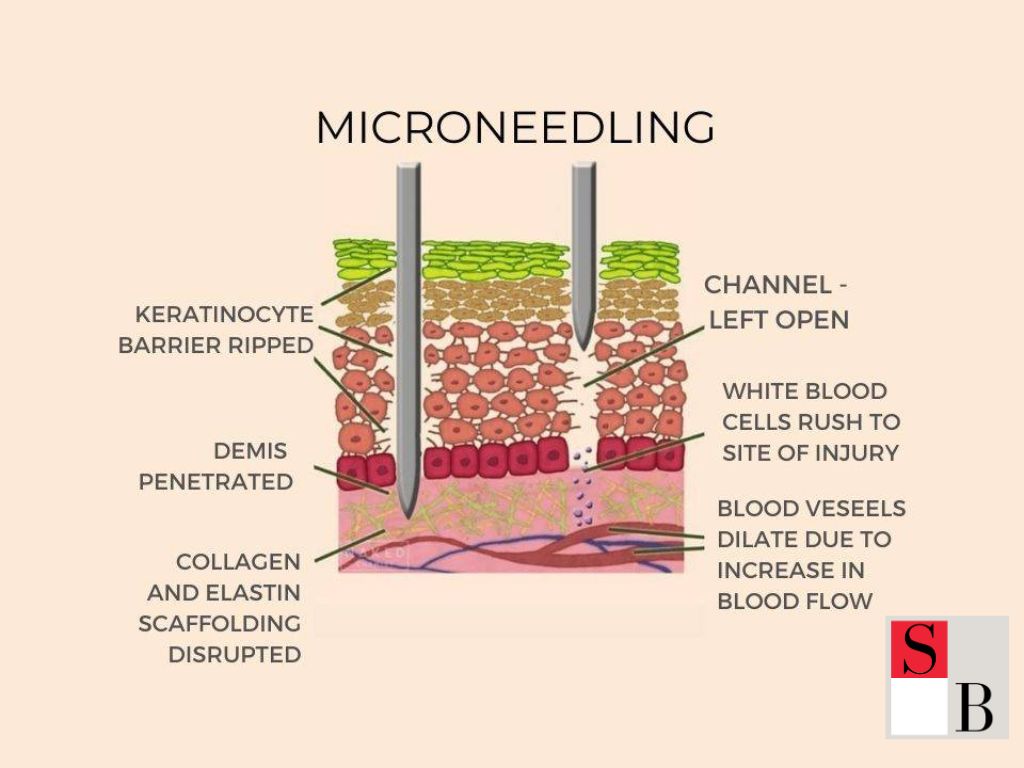What is Microneedling in Singapore?