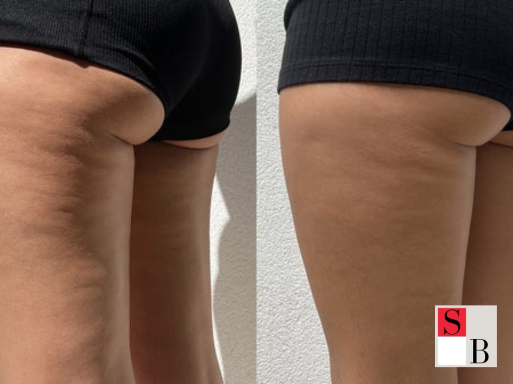 Benefits of Advanced Body Sculpting in Singapore