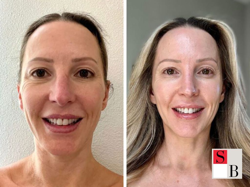 Benefits of Anti-Aging Treatments Near Somerset MRT for Asian Skin