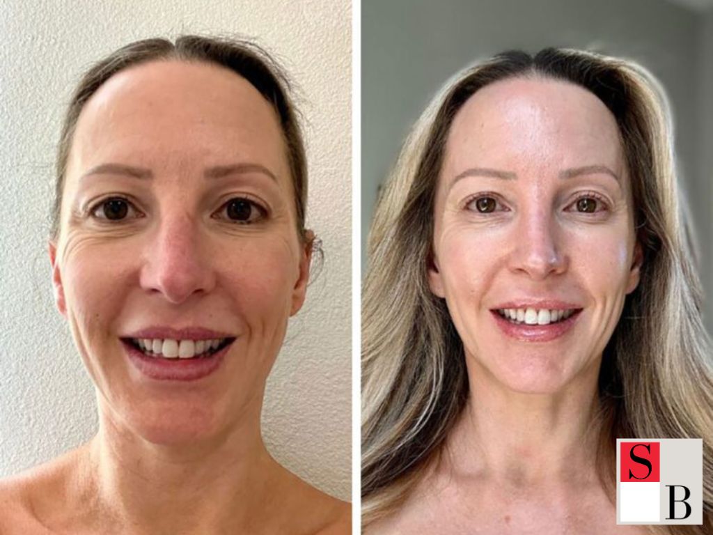 RF Microneedling Singapore: What to Expect During & After Treatment